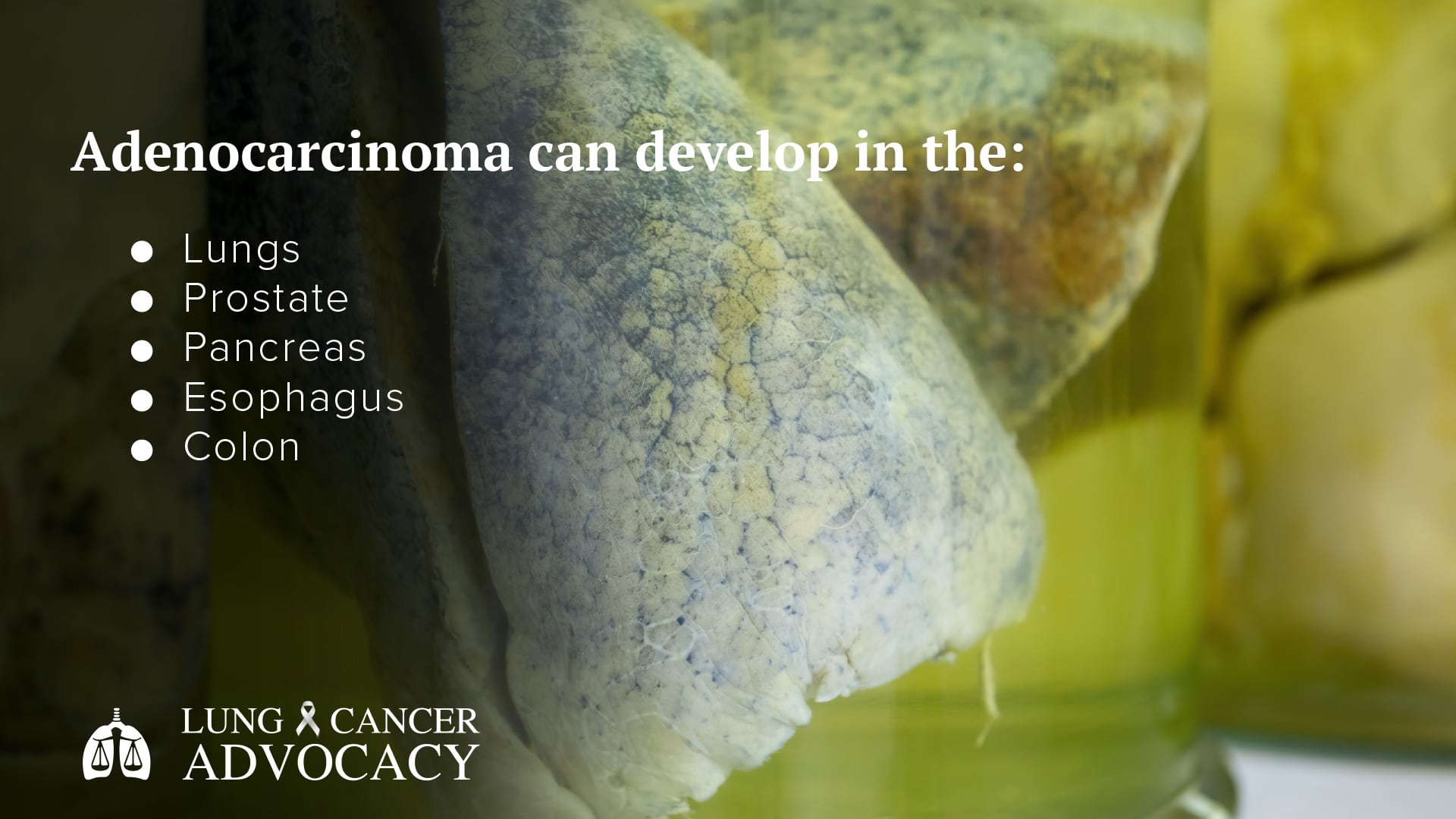 what is adenocarcinoma?