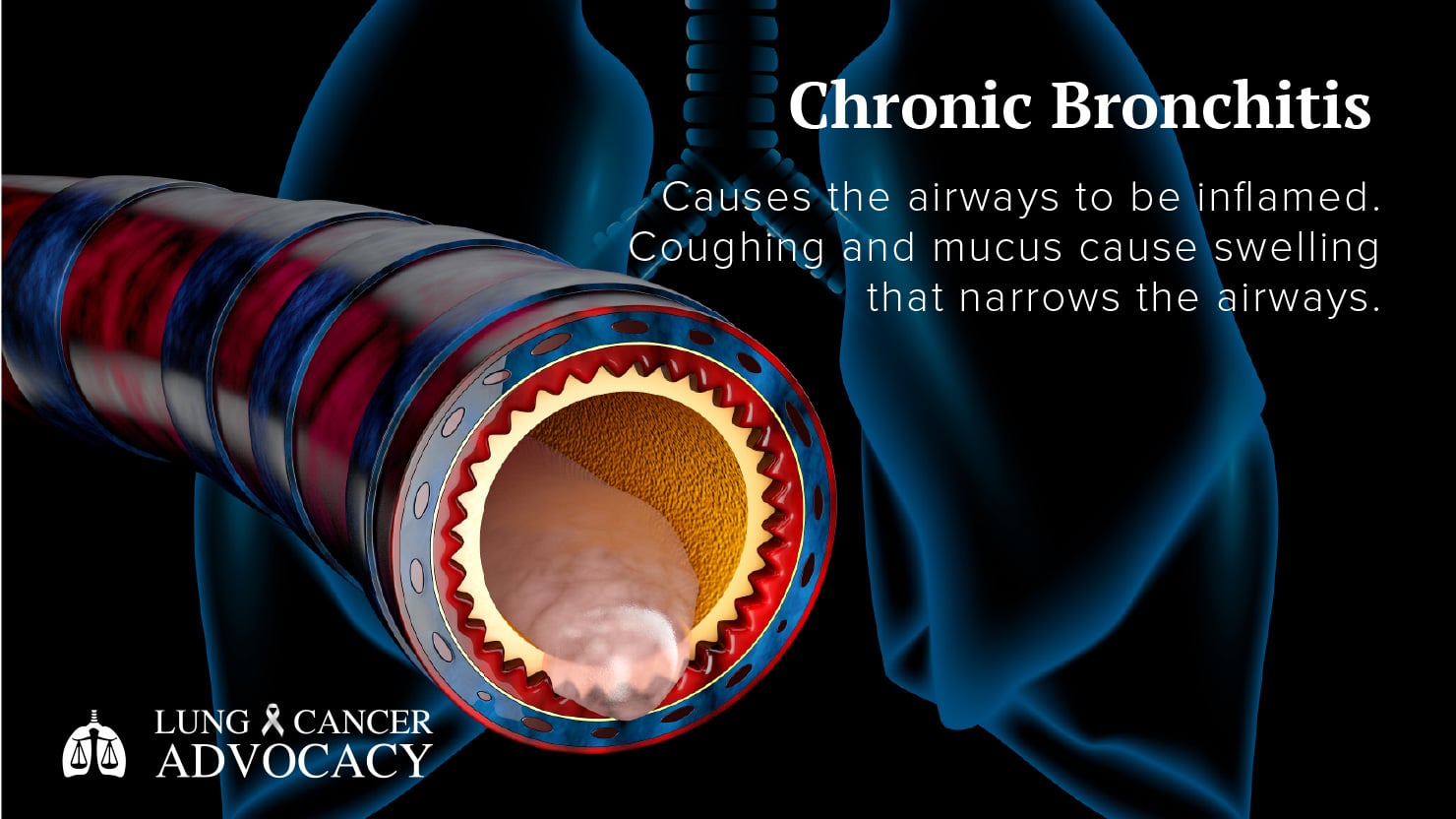 chronic bronchitis