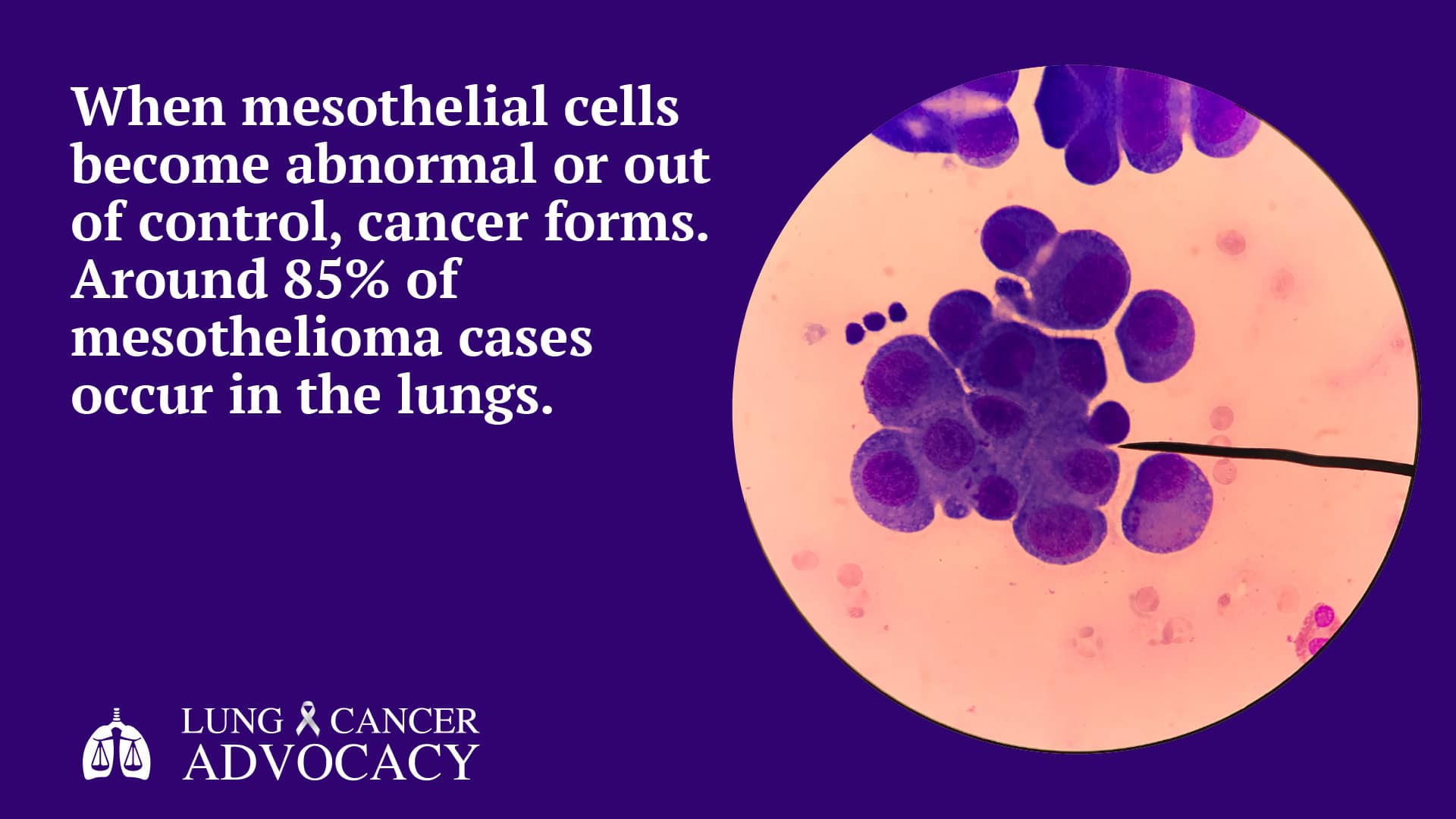 what is mesothelioma? pleural mesothelioma