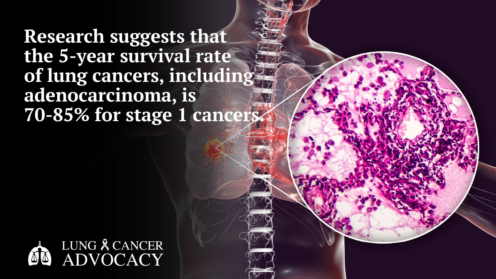 adenocarcinoma, cancer survival rate
